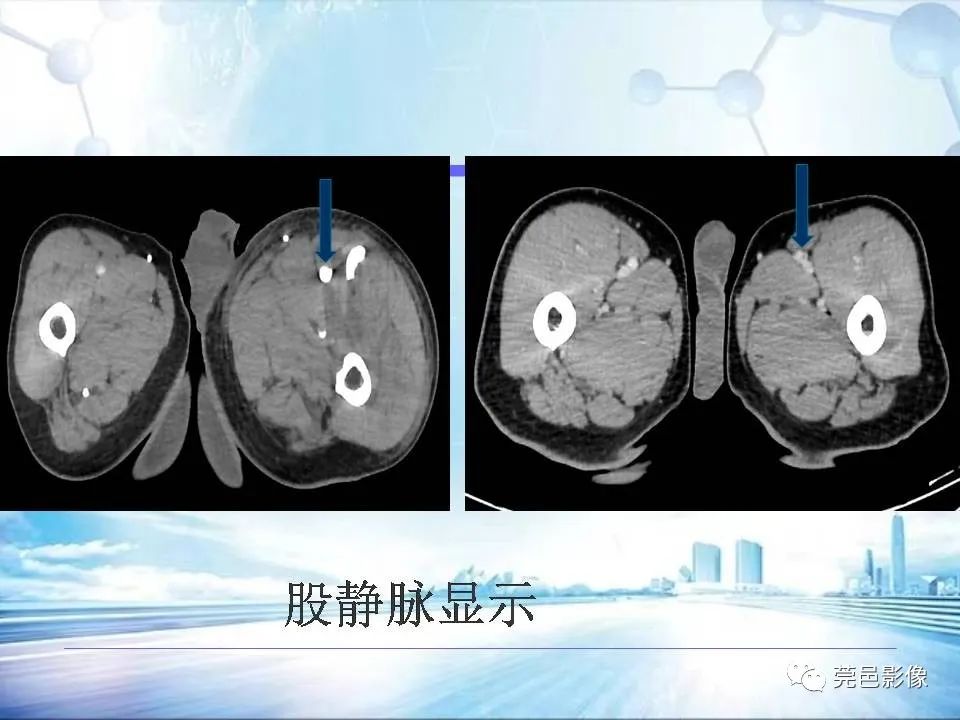 【PPT】浅谈下肢静脉CTV的应用体会-19