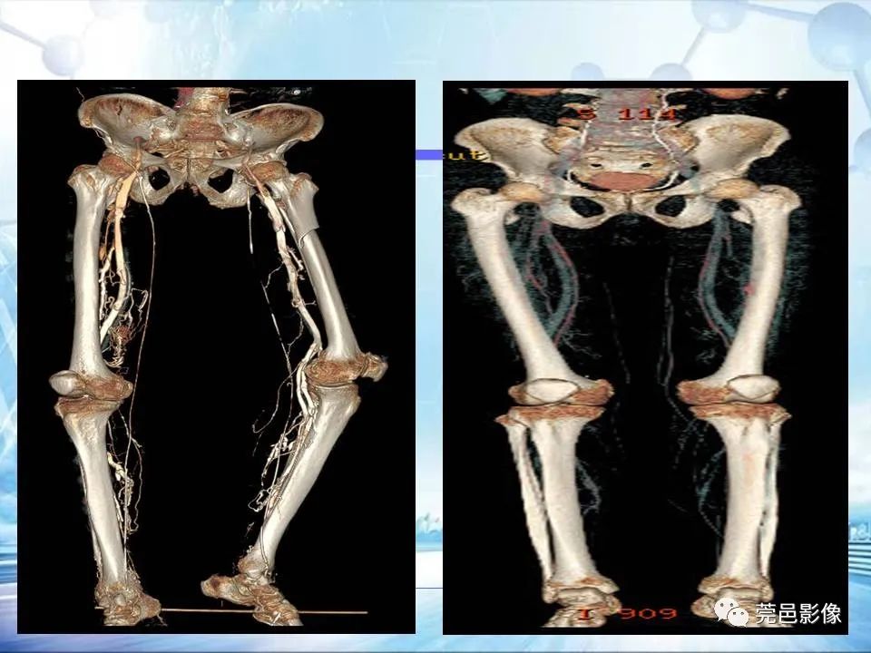 【PPT】浅谈下肢静脉CTV的应用体会-21