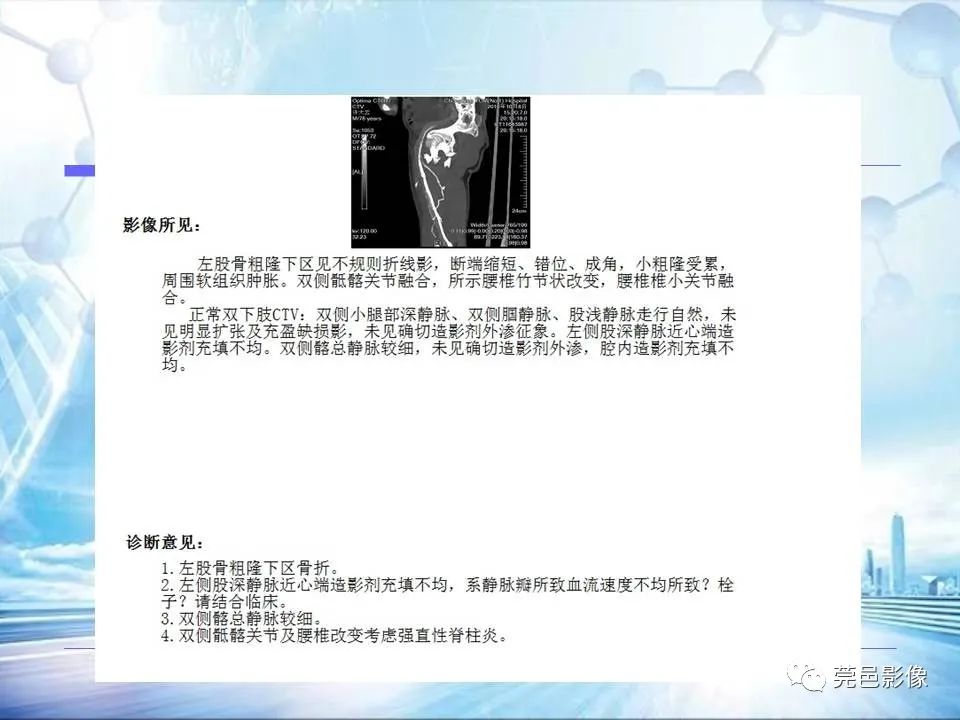【PPT】浅谈下肢静脉CTV的应用体会-24