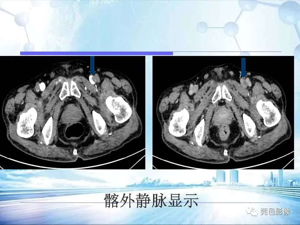 【PPT】浅谈下肢静脉CTV的应用体会-28