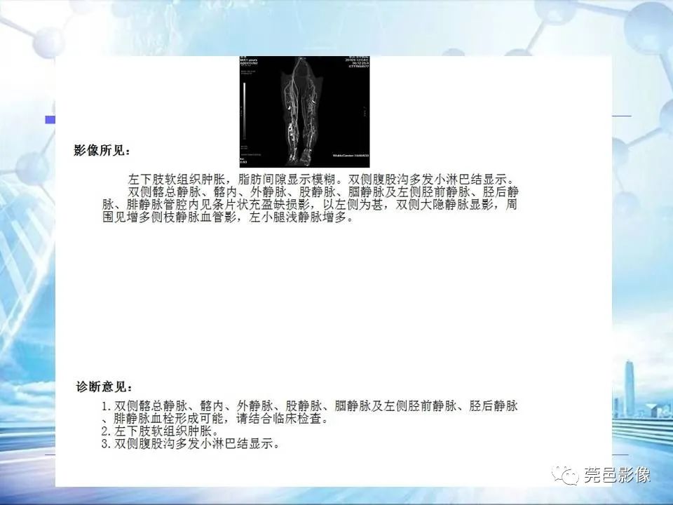 【PPT】浅谈下肢静脉CTV的应用体会-30
