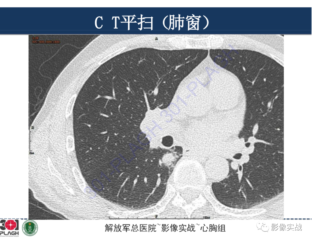 【病例】肺浸润性腺癌1例CT-4