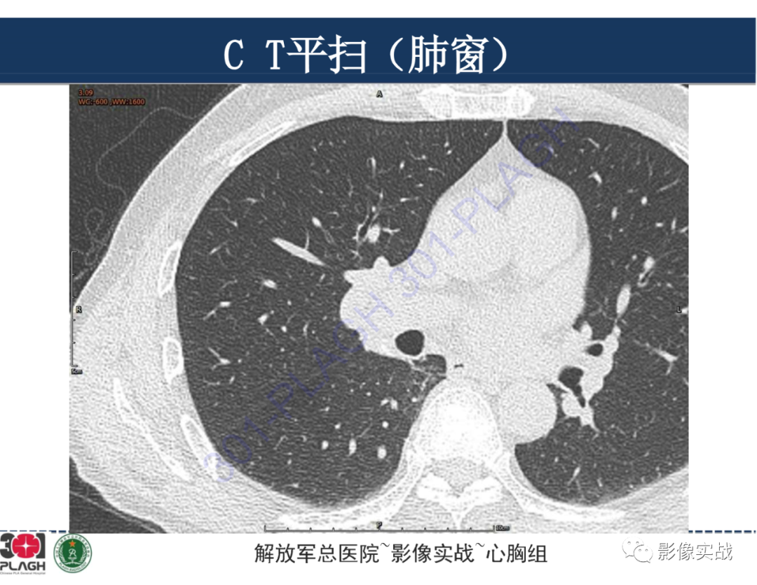 【病例】肺浸润性腺癌1例CT-3