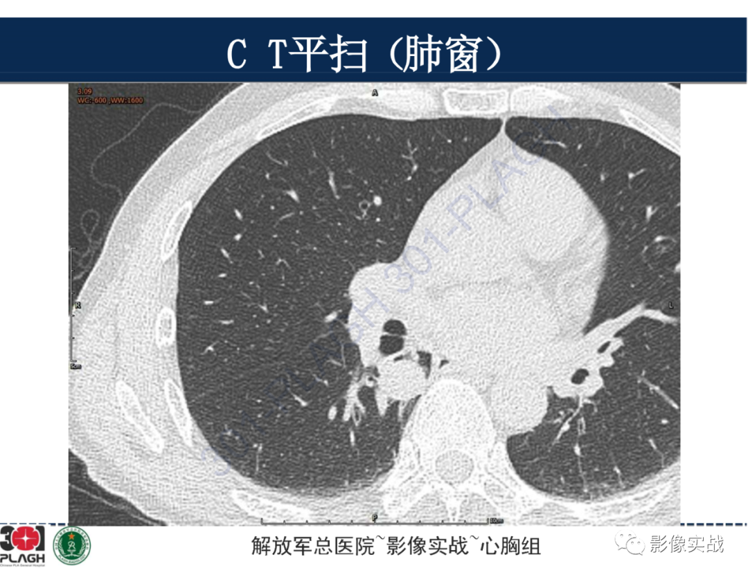 【病例】肺浸润性腺癌1例CT-6
