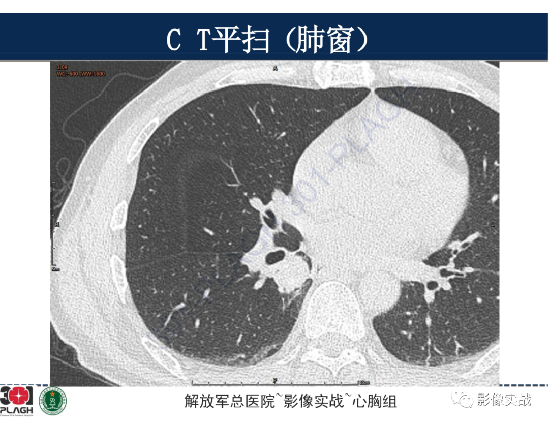 【病例】肺浸润性腺癌1例CT-7