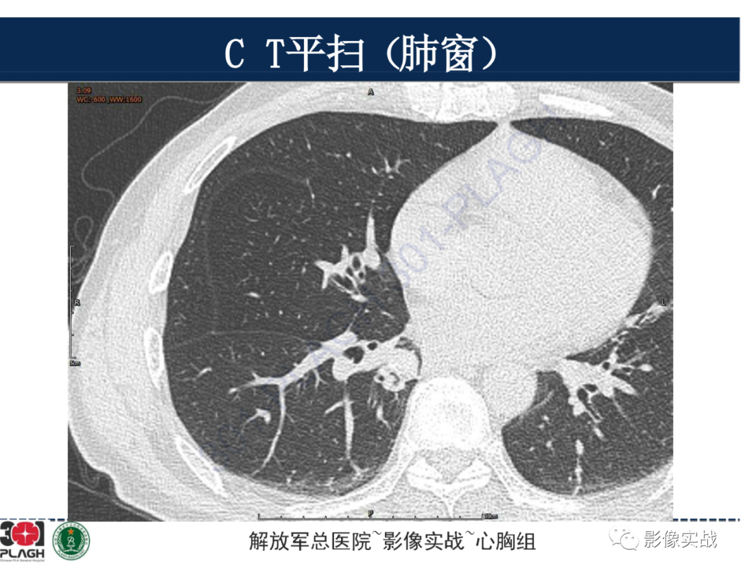 【病例】肺浸润性腺癌1例CT-8