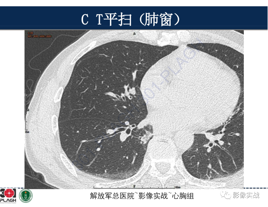 【病例】肺浸润性腺癌1例CT-9