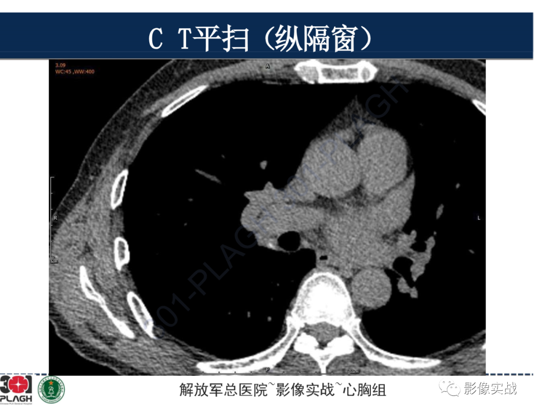 【病例】肺浸润性腺癌1例CT-10