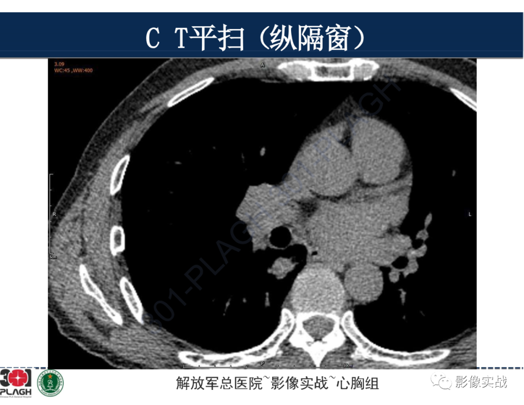 【病例】肺浸润性腺癌1例CT-11