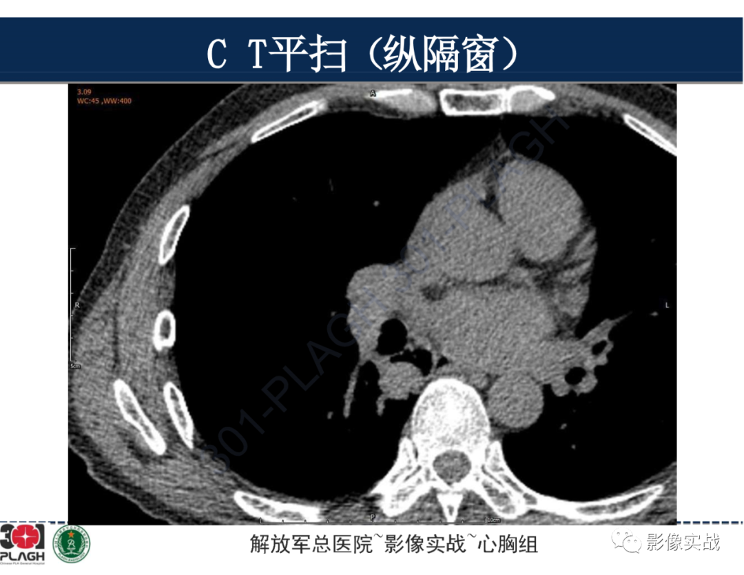 【病例】肺浸润性腺癌1例CT-12
