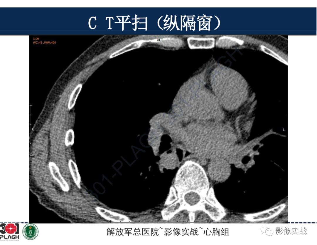 【病例】肺浸润性腺癌1例CT-13