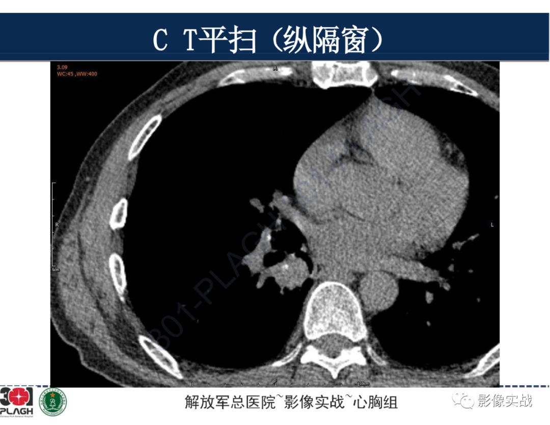 【病例】肺浸润性腺癌1例CT-14