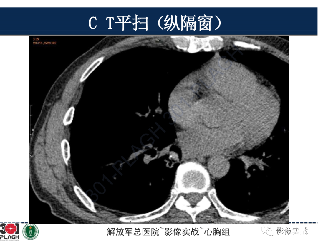 【病例】肺浸润性腺癌1例CT-15