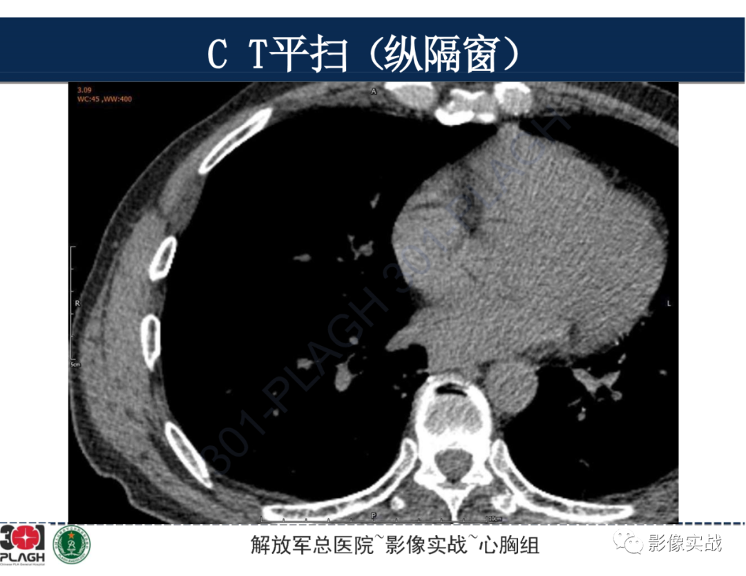 【病例】肺浸润性腺癌1例CT-16
