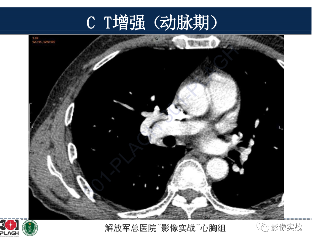 【病例】肺浸润性腺癌1例CT-17