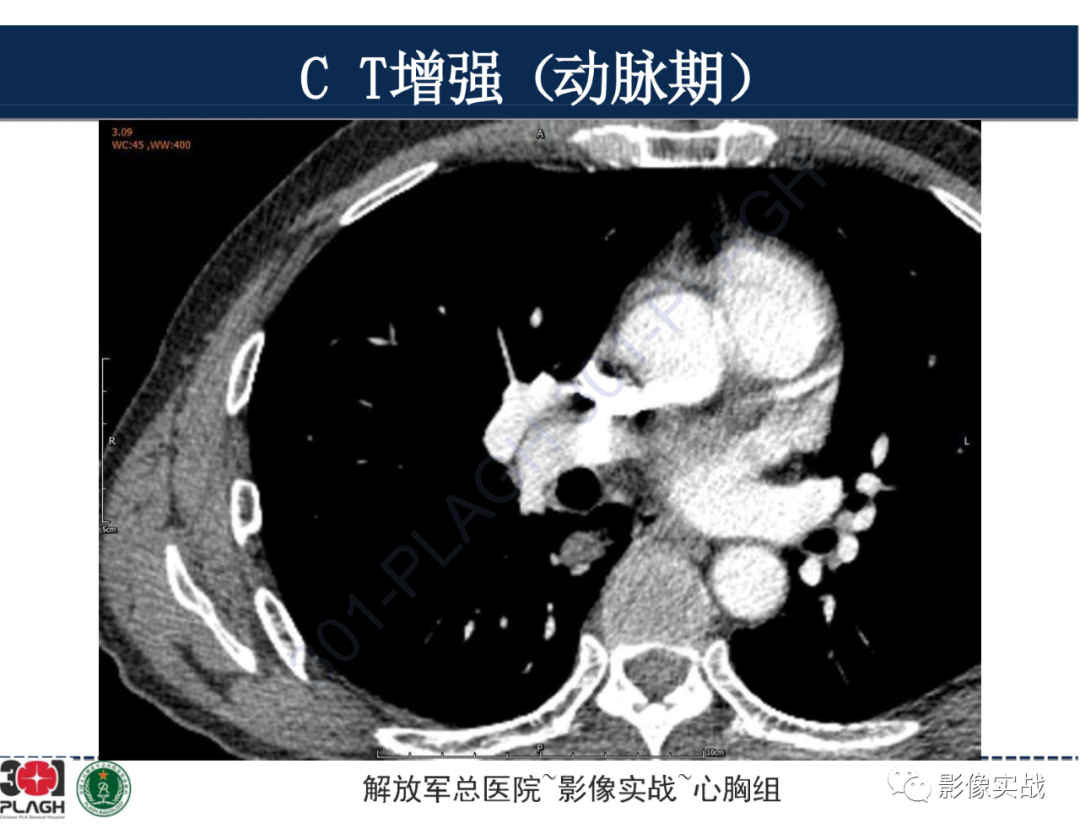 【病例】肺浸润性腺癌1例CT-18
