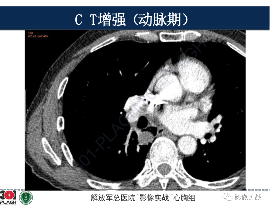 【病例】肺浸润性腺癌1例CT-19