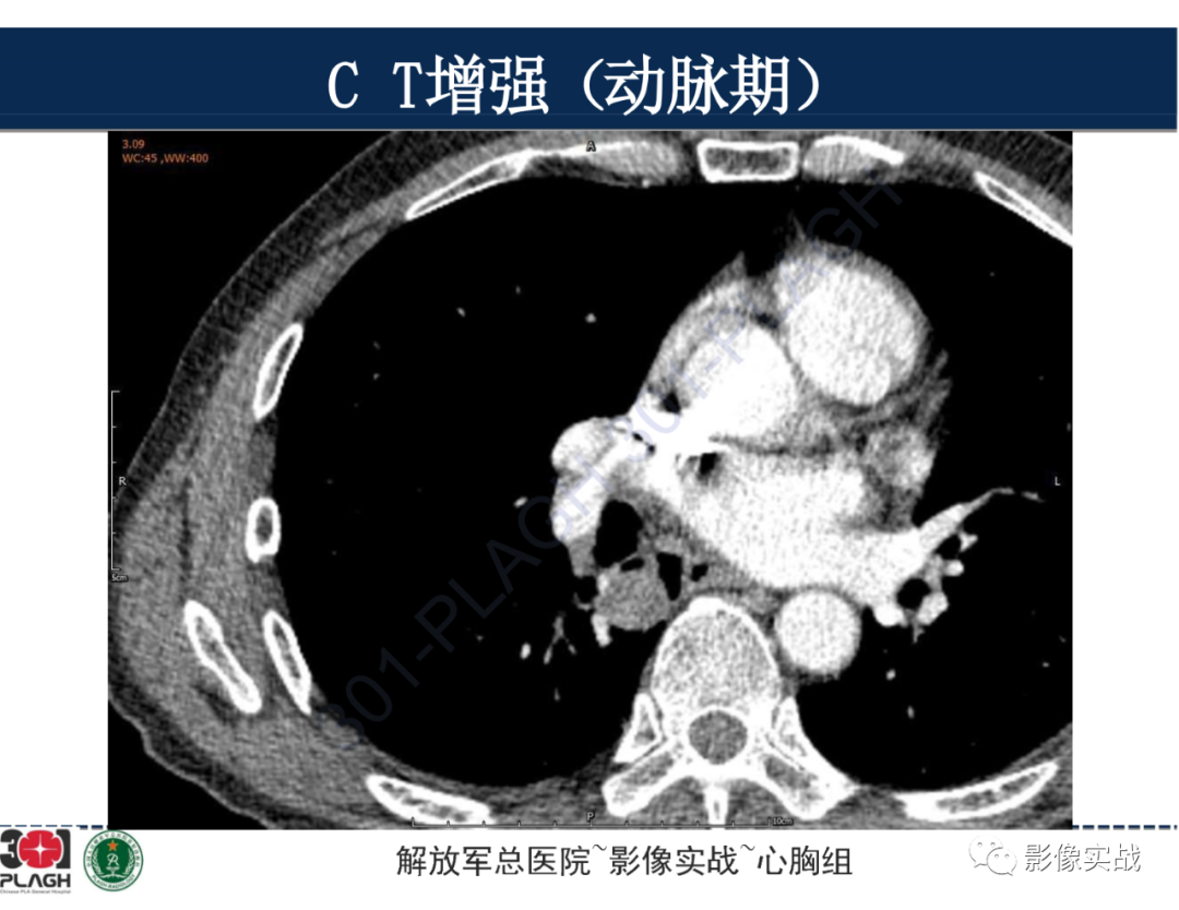 【病例】肺浸润性腺癌1例CT-20