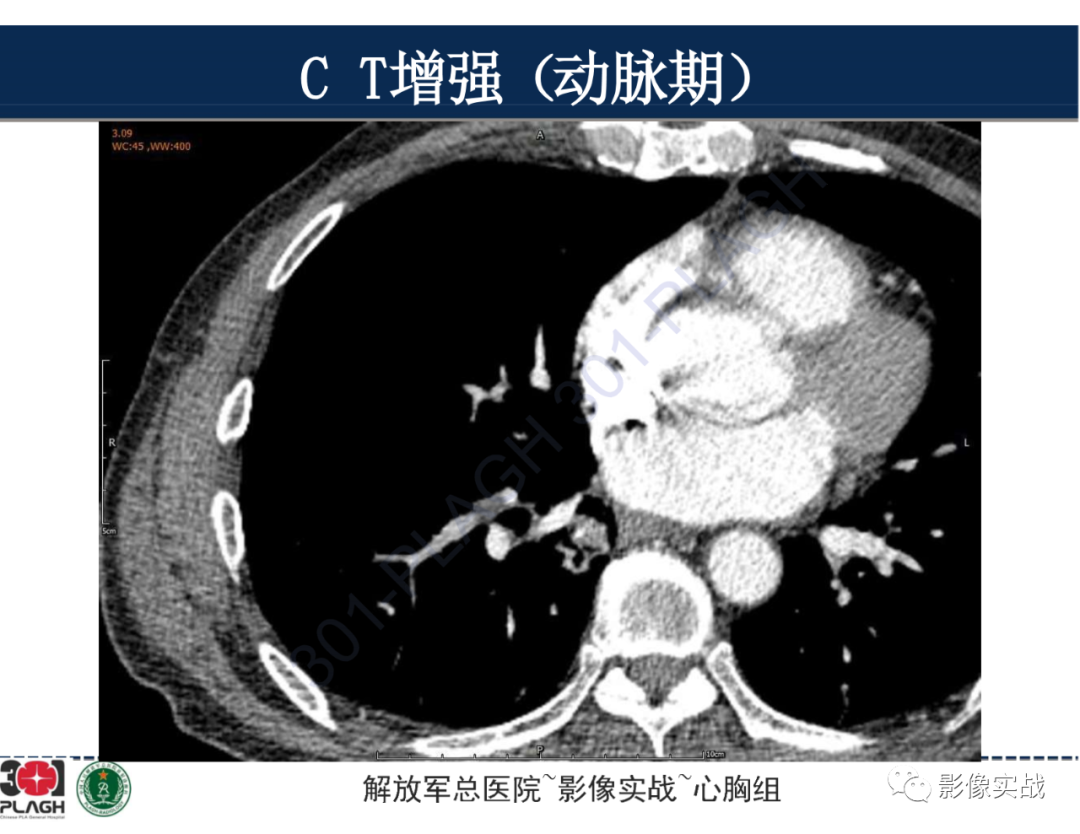 【病例】肺浸润性腺癌1例CT-22