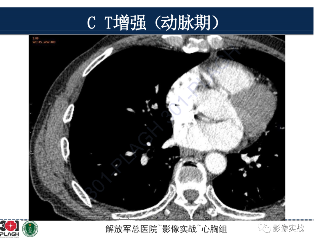 【病例】肺浸润性腺癌1例CT-23
