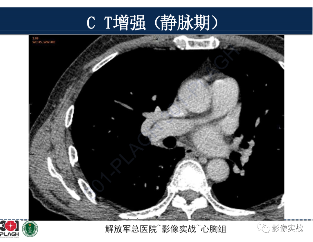 【病例】肺浸润性腺癌1例CT-24