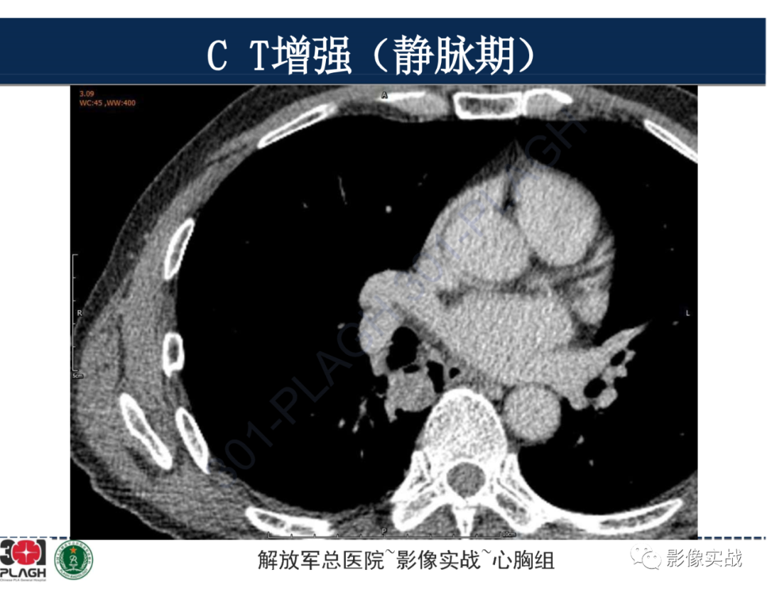 【病例】肺浸润性腺癌1例CT-26