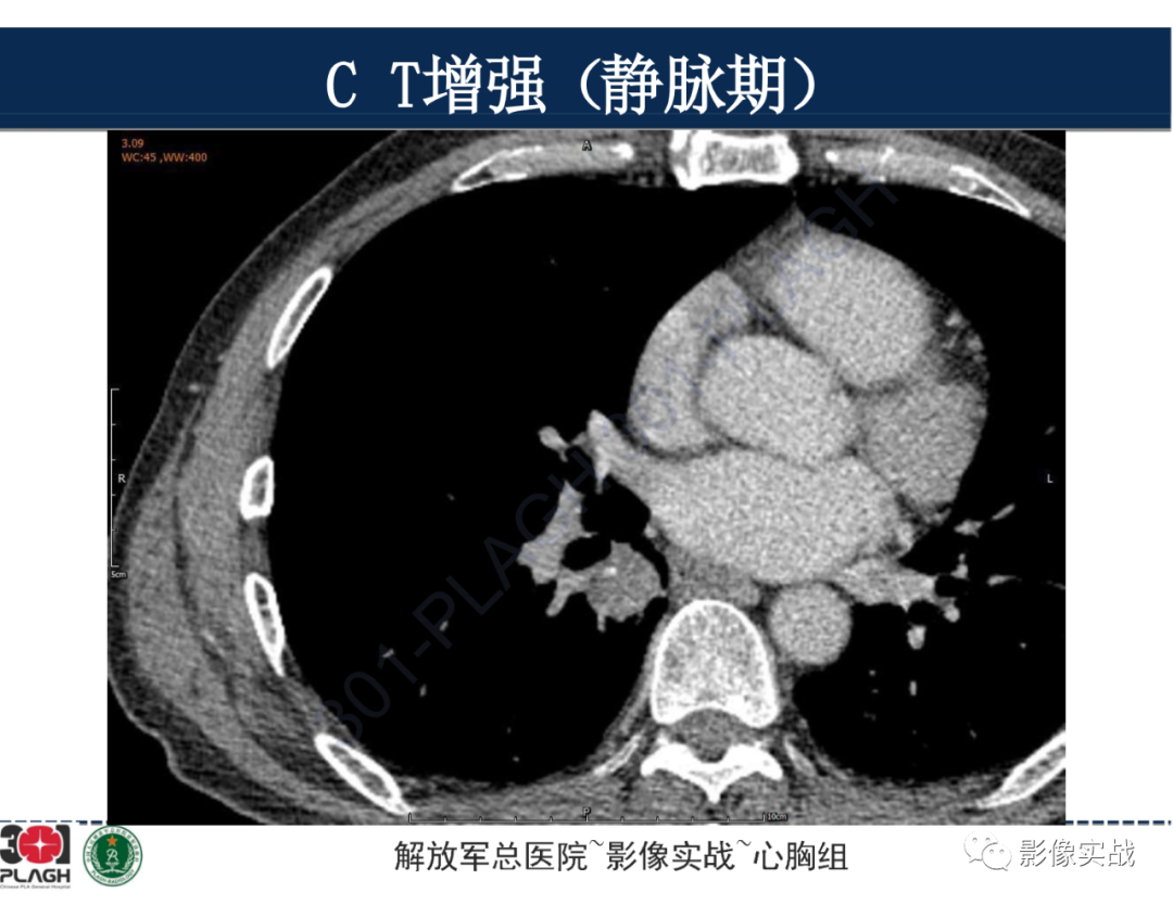 【病例】肺浸润性腺癌1例CT-27