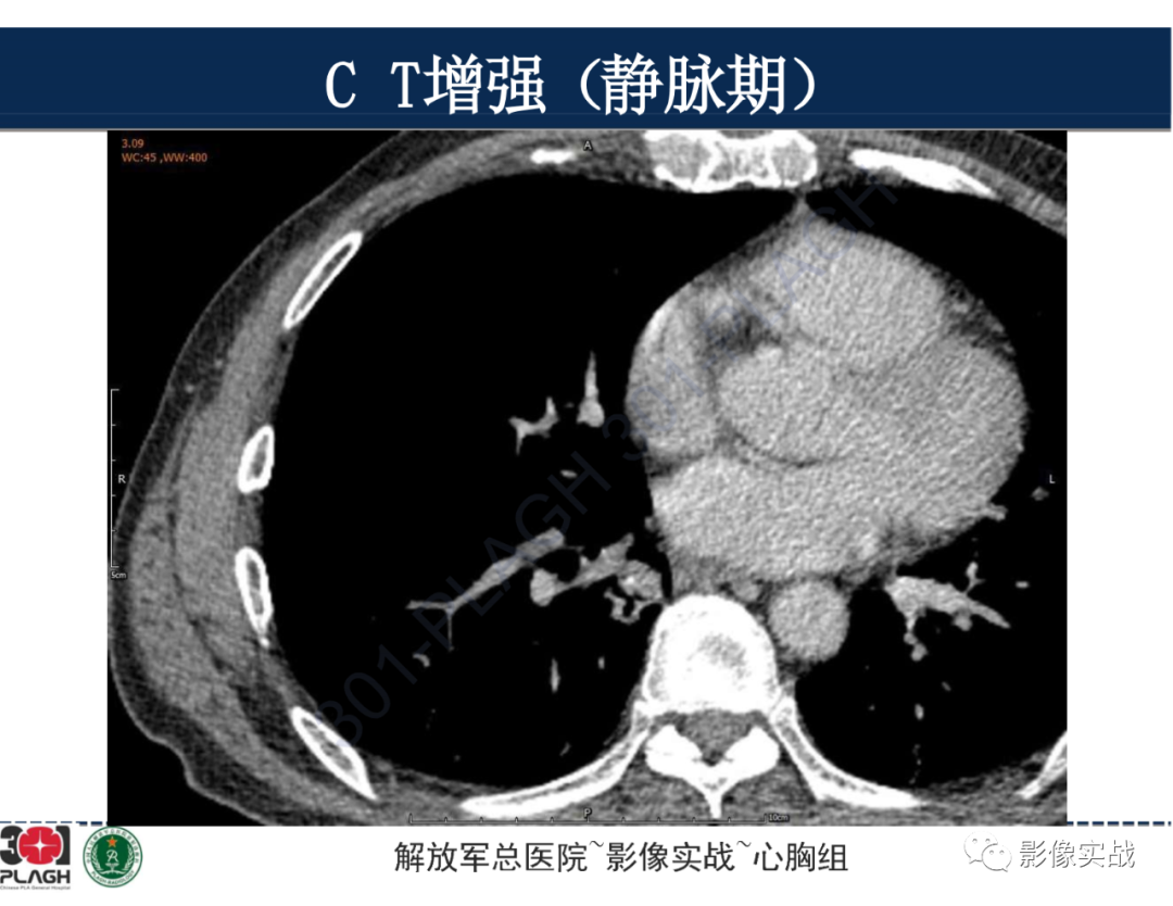 【病例】肺浸润性腺癌1例CT-28