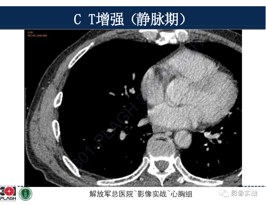 【病例】肺浸润性腺癌1例CT-29