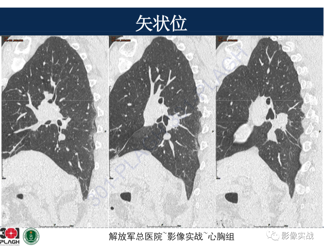 【病例】肺浸润性腺癌1例CT-30