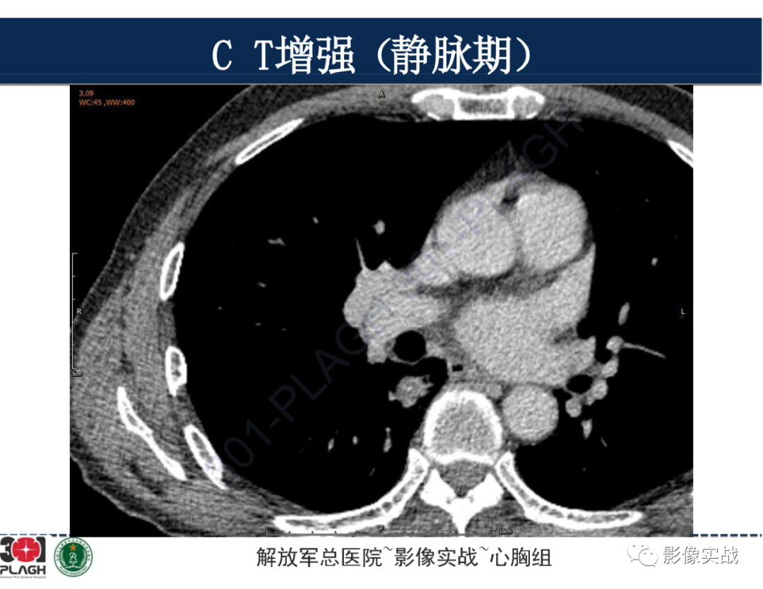 【病例】肺浸润性腺癌1例CT-25