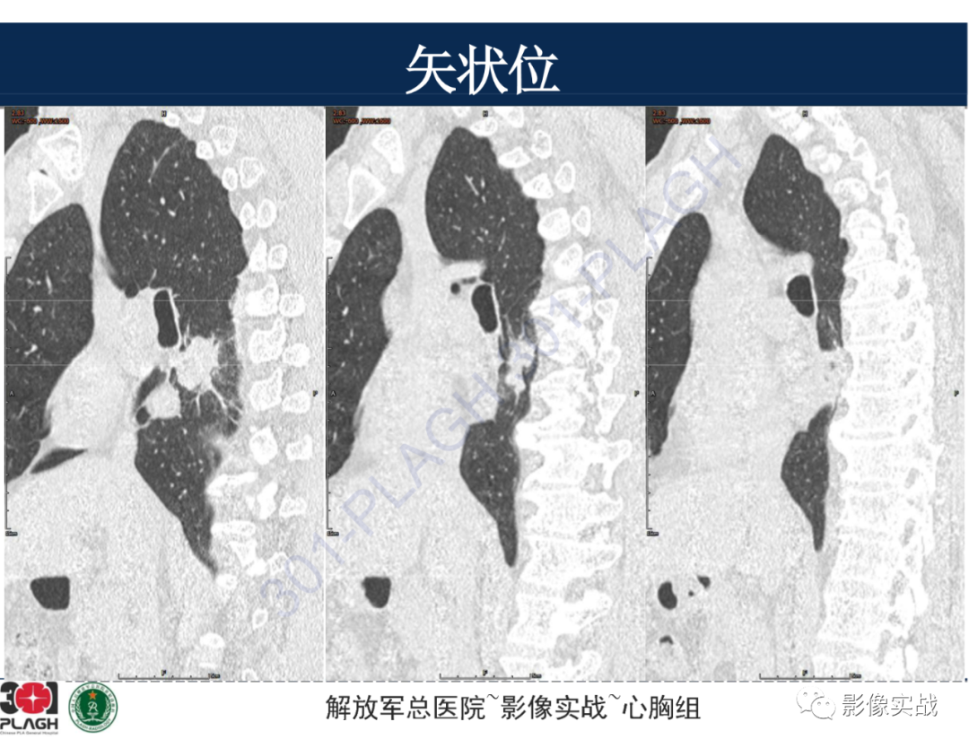 【病例】肺浸润性腺癌1例CT-31