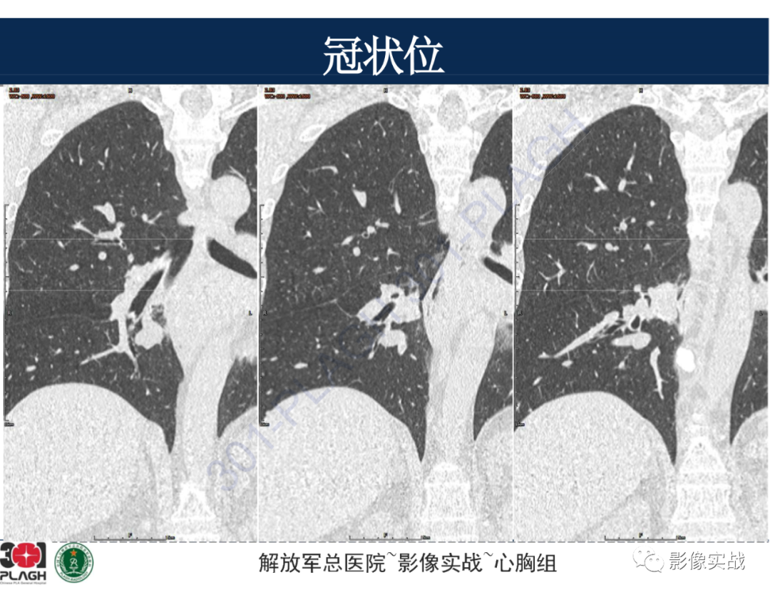 【病例】肺浸润性腺癌1例CT-32