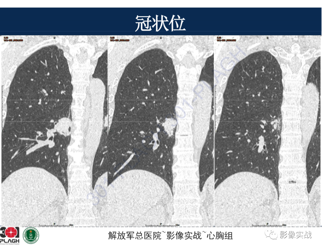 【病例】肺浸润性腺癌1例CT-33