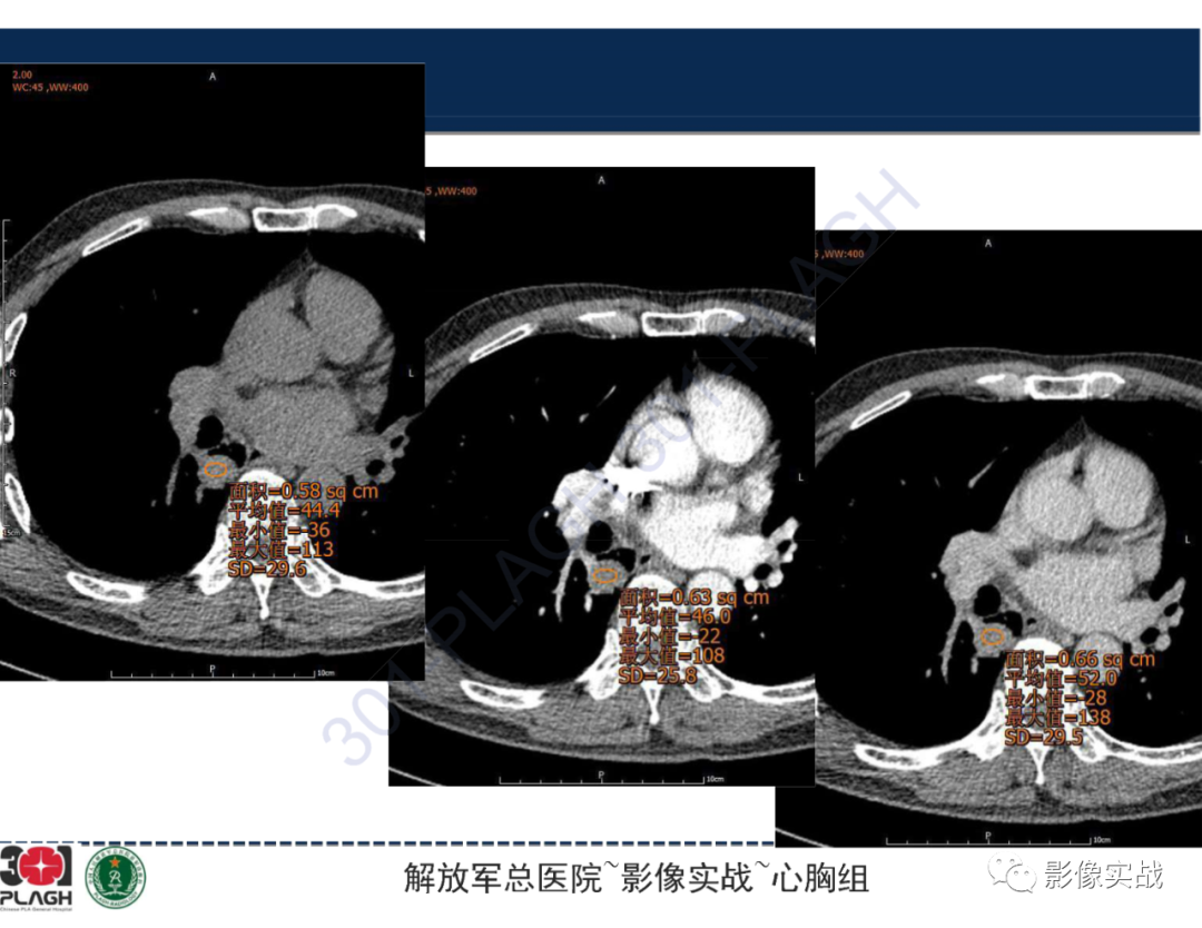 【病例】肺浸润性腺癌1例CT-34