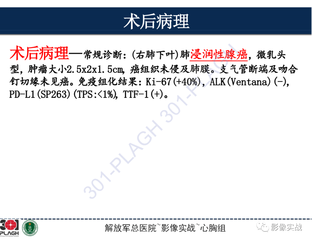 【病例】肺浸润性腺癌1例CT-36