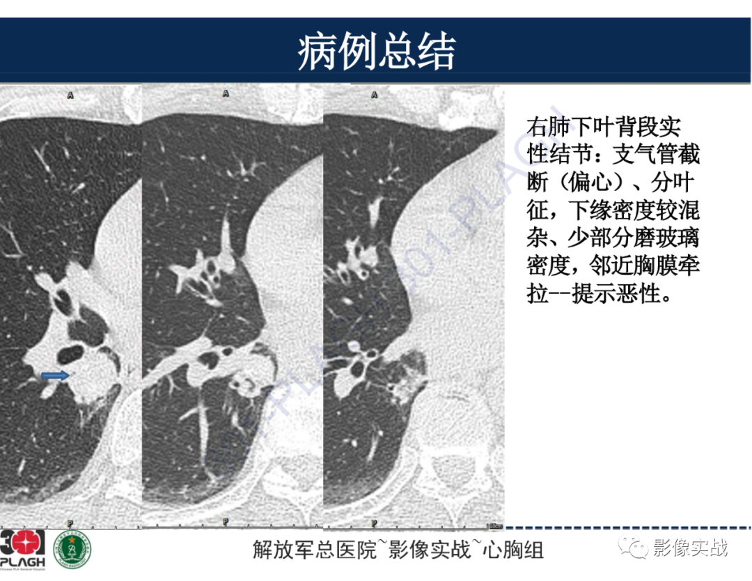 【病例】肺浸润性腺癌1例CT-37