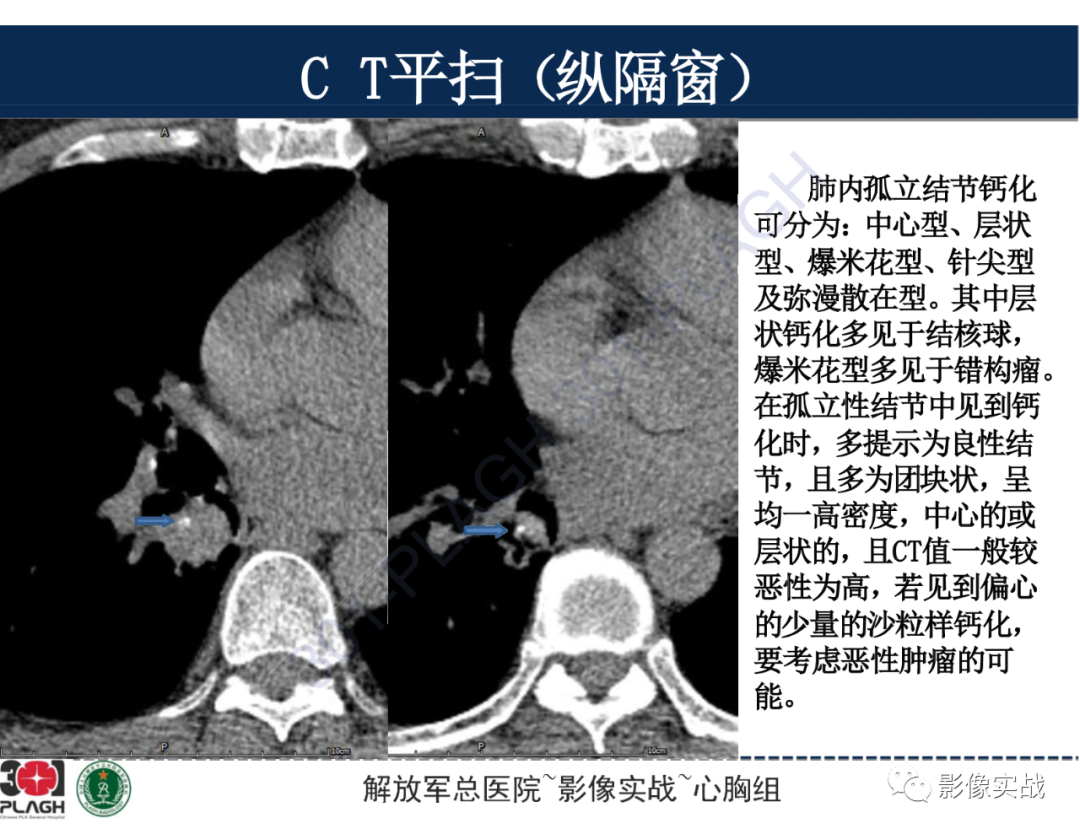 【病例】肺浸润性腺癌1例CT-38