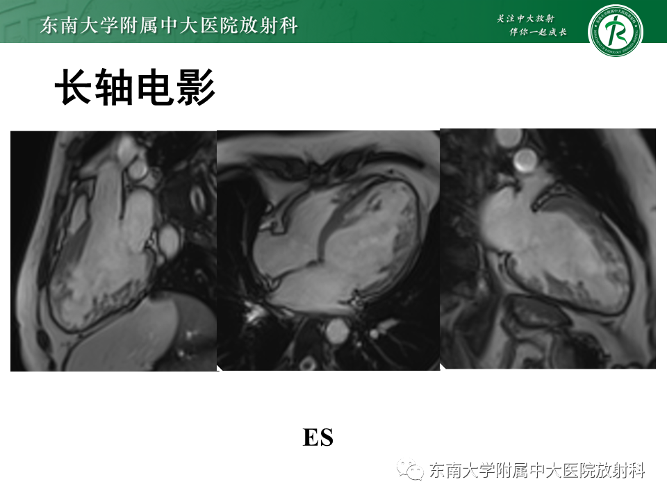 【PPT】心肌致密化不全-5