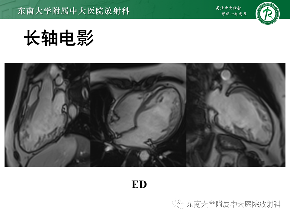 【PPT】心肌致密化不全-4