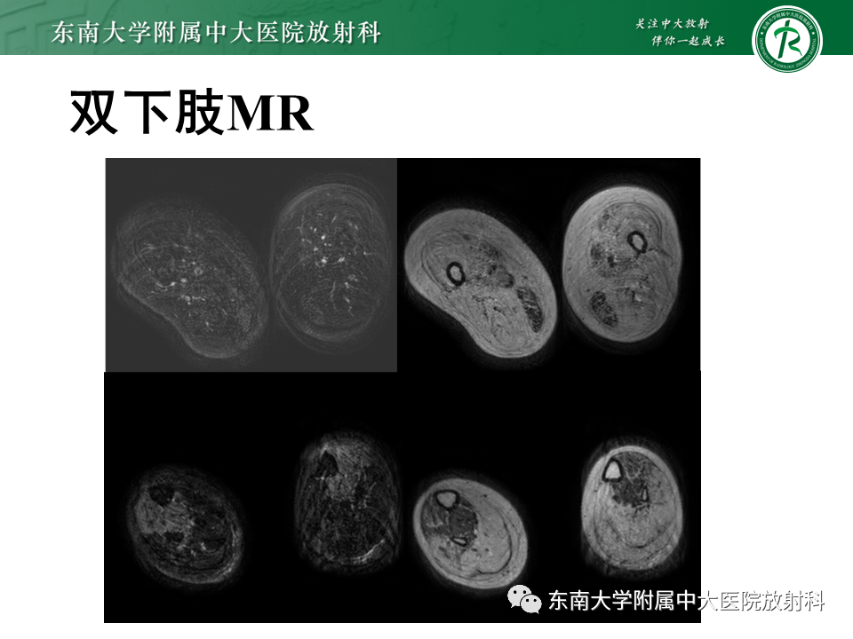 【PPT】心肌致密化不全-2