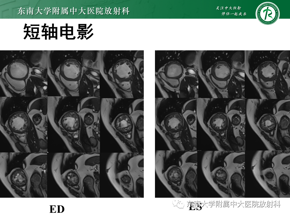 【PPT】心肌致密化不全-3