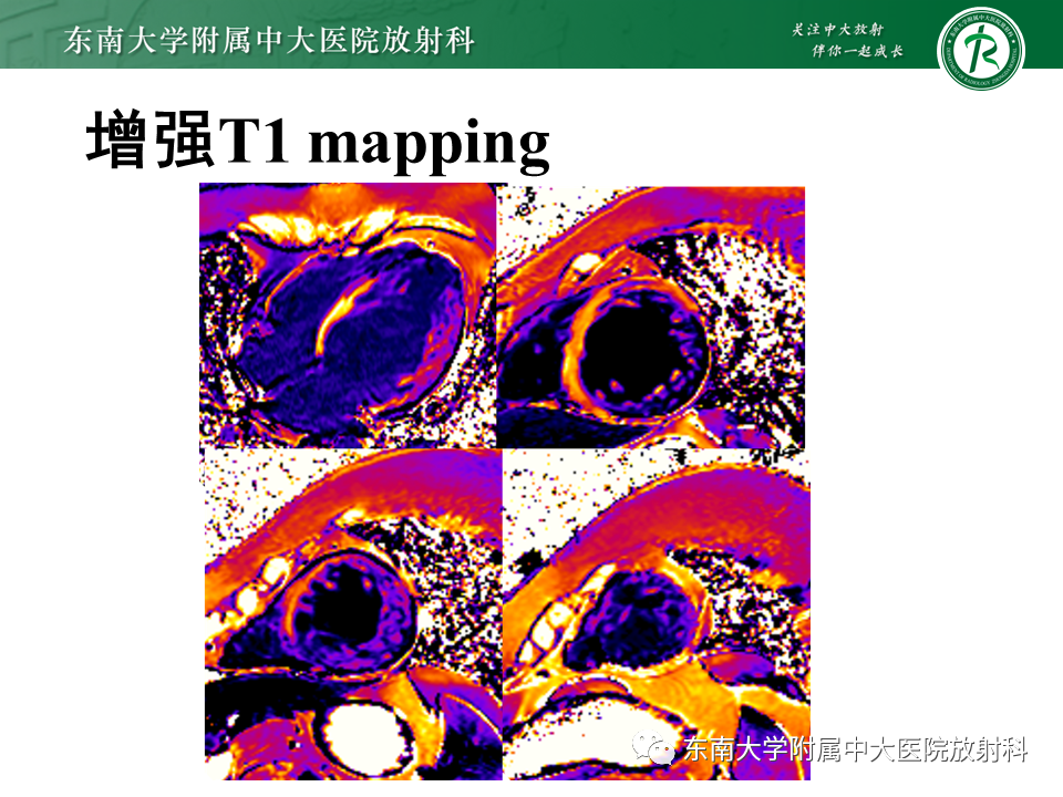 【PPT】心肌致密化不全-6