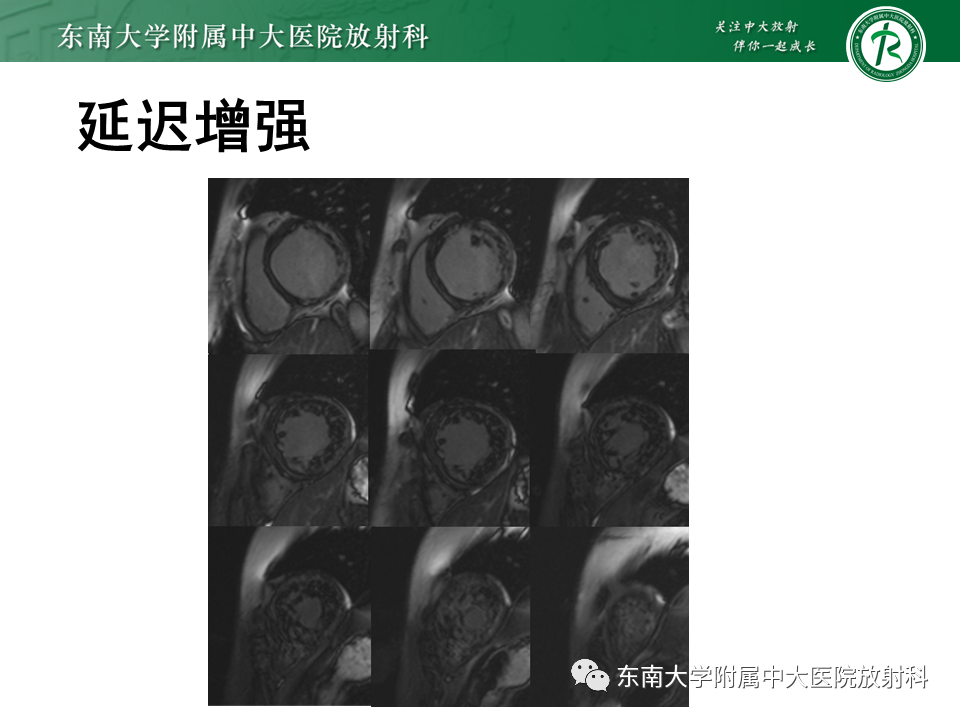 【PPT】心肌致密化不全-7