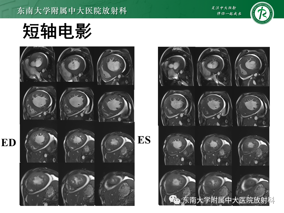 【PPT】心肌致密化不全-11