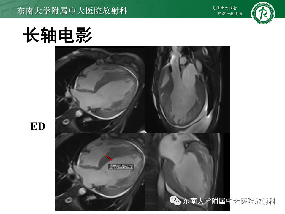 【PPT】心肌致密化不全-12