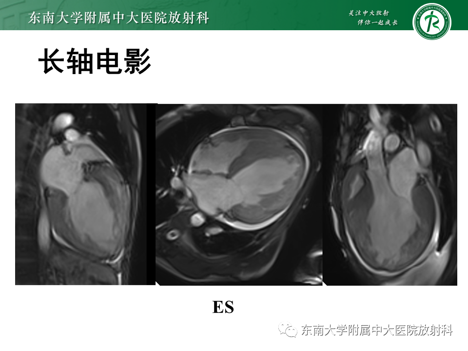 【PPT】心肌致密化不全-13
