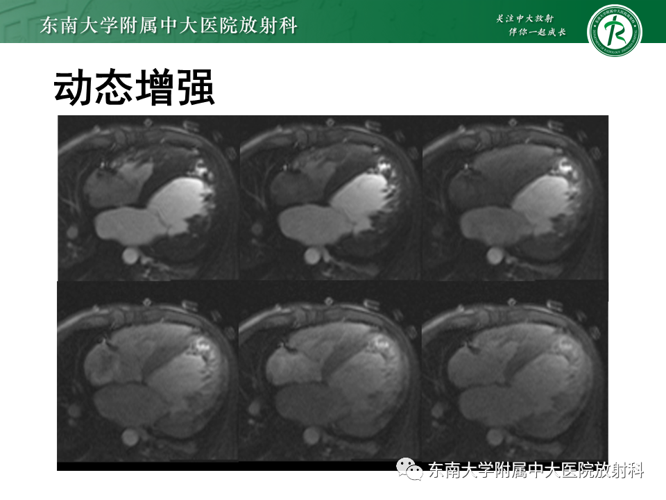 【PPT】心肌致密化不全-14