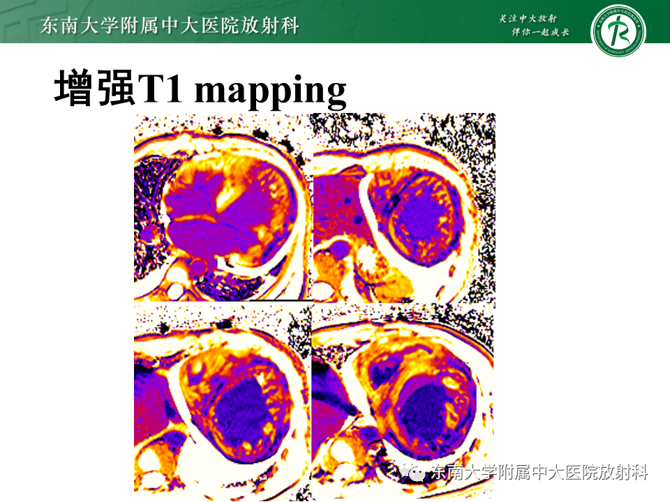 【PPT】心肌致密化不全-15