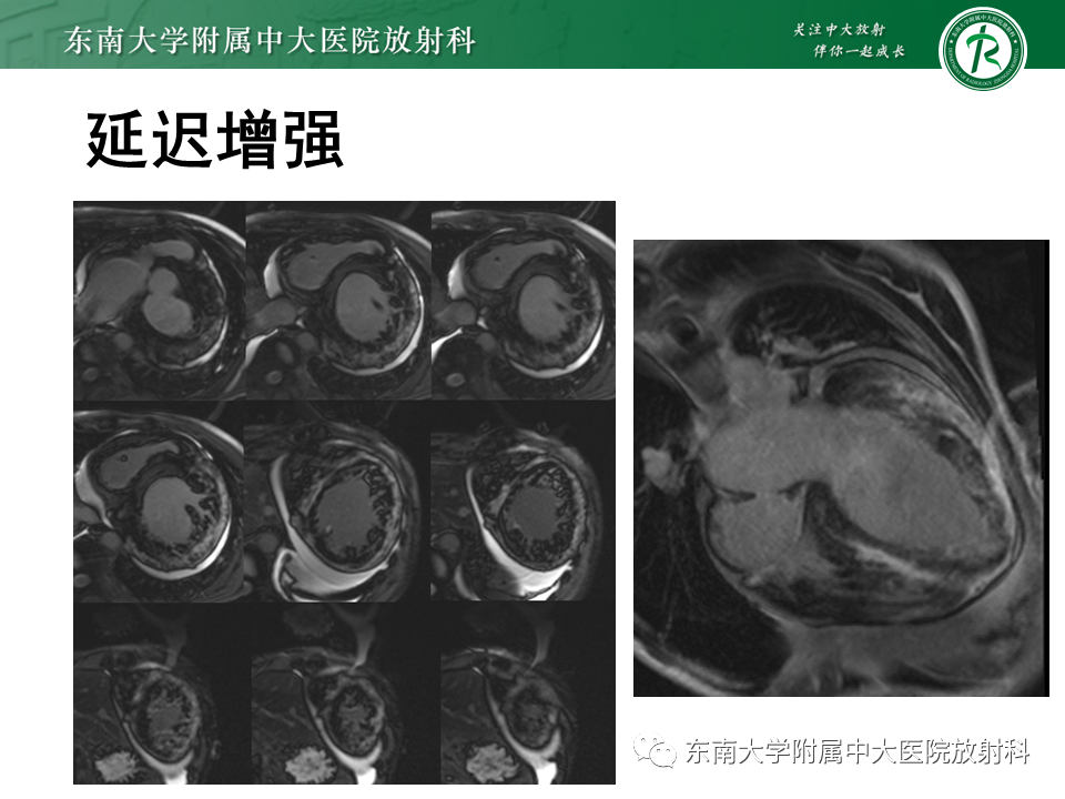 【PPT】心肌致密化不全-16
